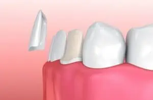 dental veneers